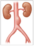 <p>What aneurysm shape is the following </p><ul><li><p>bulging on one side</p></li></ul><p></p>