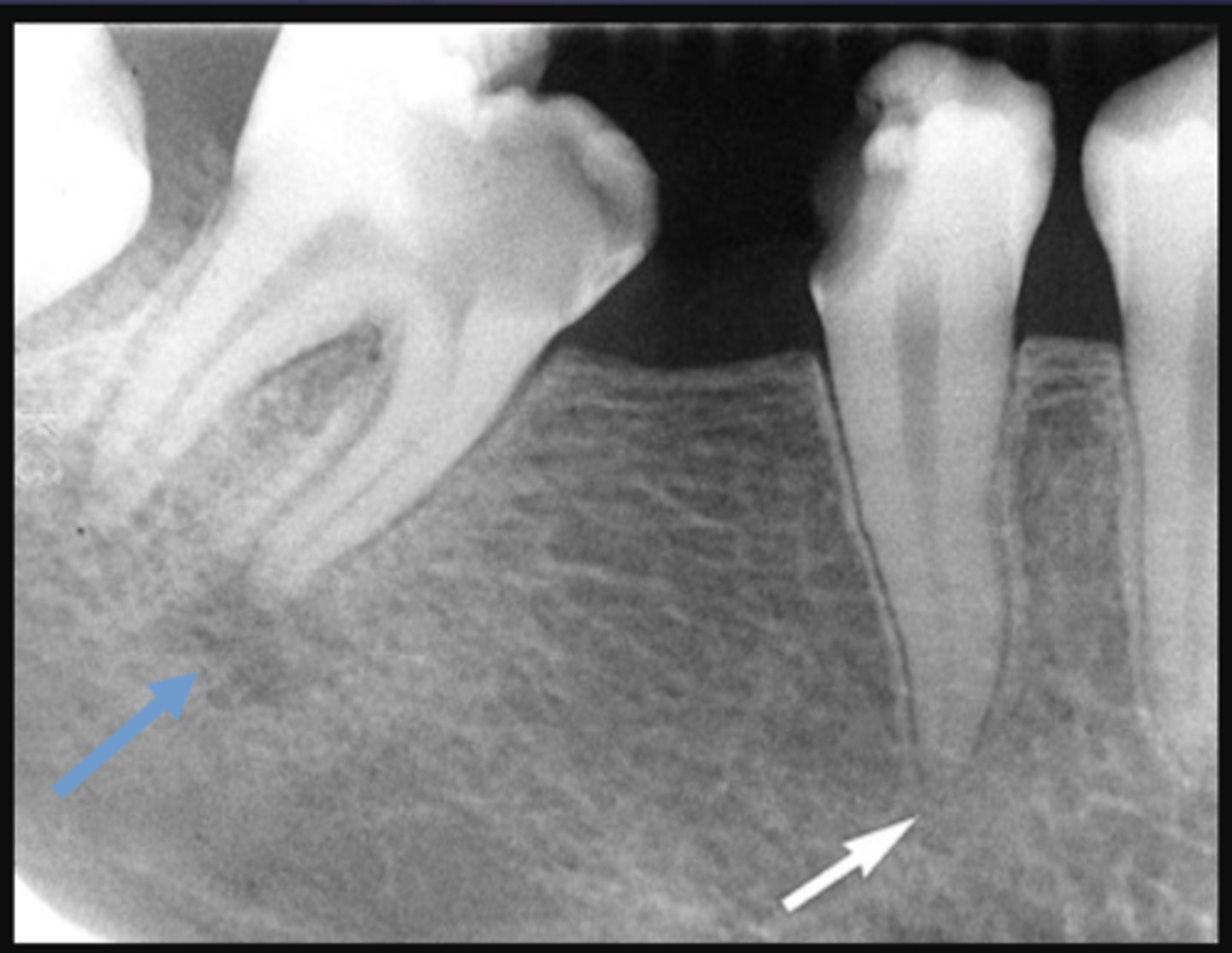 <p>The blue arrow is showing what type of lesion?</p>