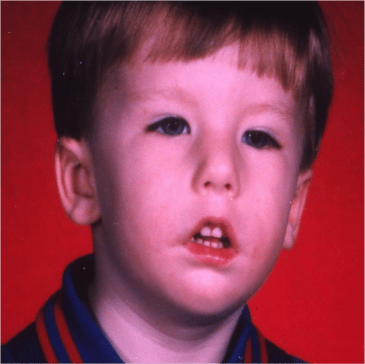 <p>sometimes autosomal dominant, agenesis or aplasia of motor nuclei of cranial nerves</p><p>Facial and hypoglossal and sometimes trigeminal nerve involvement.</p><p>Decreased articulatory speed, range and strength</p><p>Mild to severe artic disorders, with bilabial, linguadental, and lingua-alveolar sounds most affected.</p><p>sometimes conductive HL and delayed language</p>