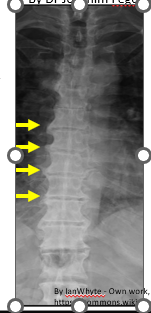 <p>Aka <strong><span style="color: red">Forestier disease</span></strong></p><p>Common condition - <strong><em>bony proliferation site of tendinous and ligamentous insertion of the spine</em></strong> (at least four contiguous bodies) - affects elderly individuals</p><p>Characterized by <strong><em>flowing ossification of ALL</em></strong> - cervical and thoracic spine and enthesopathies.</p>