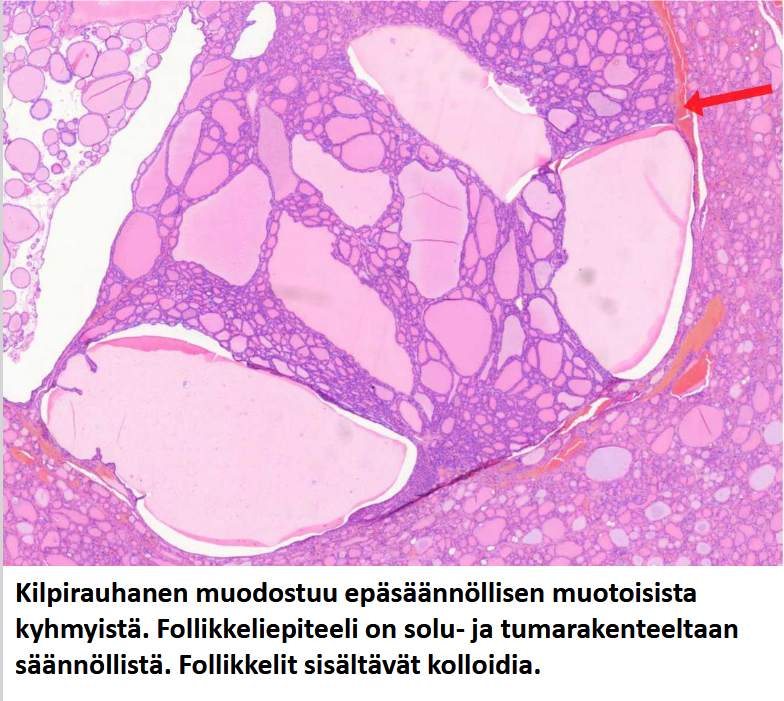 <p><strong><u>MIKÄ TAUTI? </u></strong>Kilpirauhanen muodostuu epäsäännöllisen muotoisista kyhmyistä. Follikkeliepiteeli on solu- ja tumarakenteeltaan säännöllistä. Follikkelit sisältävät kolloidia.</p>