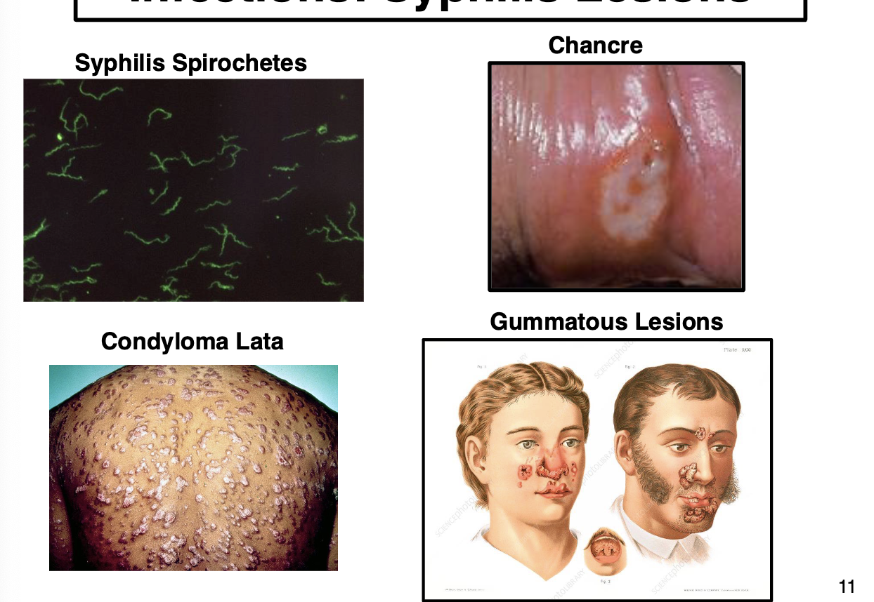 <ul><li><p>caused by <em>Treponema pallidum</em>. Infection has 3 distinct stages if not treated</p></li><li><p><u>Primary syphilis</u>: characterized by a <strong>chancre</strong>, a solitary painless ulceration at site of infection, appear ab 1-3 weeks after exposure, may persist for 3-6 weeks w/o treatment</p></li><li><p><u>secondary syphilis</u>: characterized by a <em>systemic spread</em> of spirochetes and a skin lesion known as <strong>Condyloma lata</strong>, multiple slightly raised lesions, appear 2 months to 2 yrs after infection</p></li><li><p><u>tertiary syphilis</u>: rare, characterized by a lesion known as <strong>Gumma</strong>, soft and rubbery non-cancerous growth filled granulomas, appears 2-20 yrs after infection, can be very disfiguring. Can also involve <span data-name="heart" data-type="emoji">❤</span> and CNS </p></li></ul><p></p>
