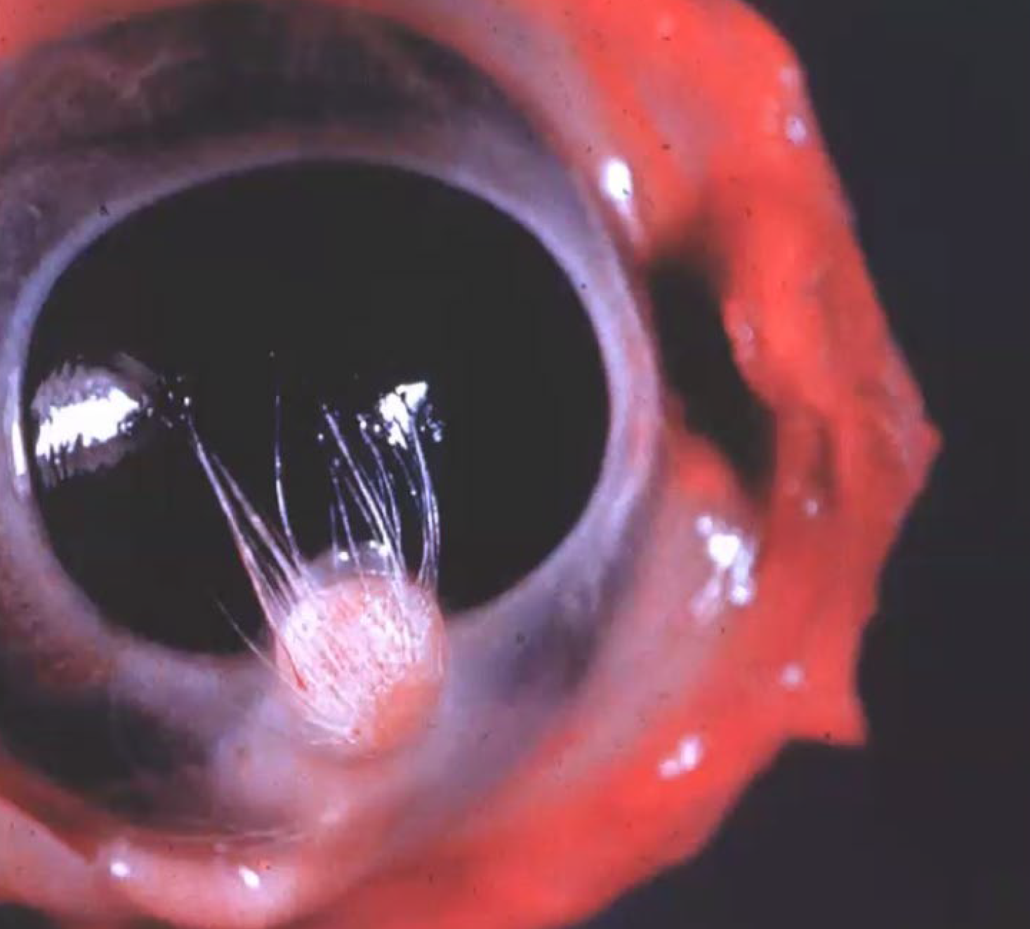 <p>What is the condition?</p><p>A-Choristoma</p><p>B-Teratoma</p><p>C-Hamartoma</p><p>D-Squamous cell carcinoma</p>