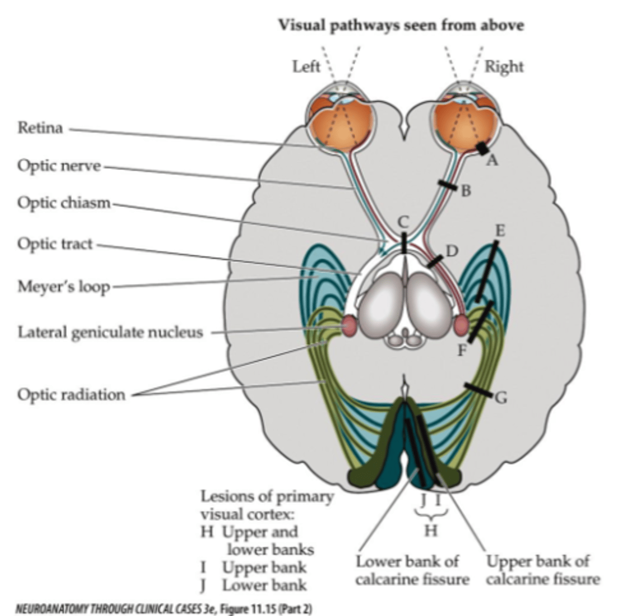<p>Optic chiasm (pituitary gland tumor)</p>