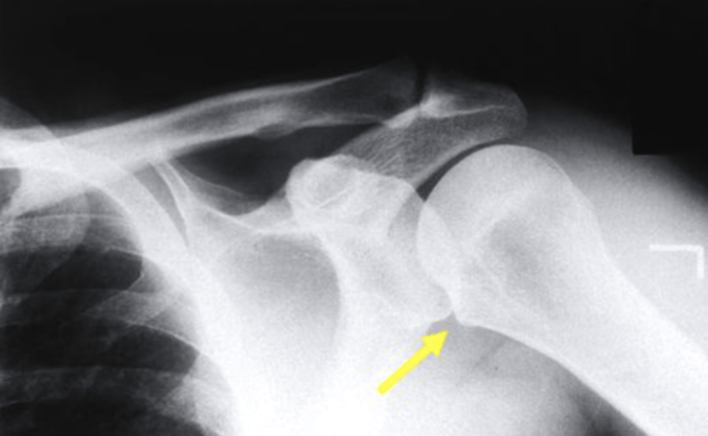 <p>lesser tuberosity</p><p>3 multiple choice options</p>