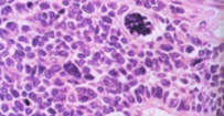 <p>Cell reversion to a more primitive &amp; undifferentiated type</p>