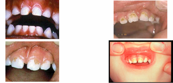 <p>-enamel breakdown</p>
