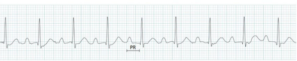 <p>What does this EKG show?</p>