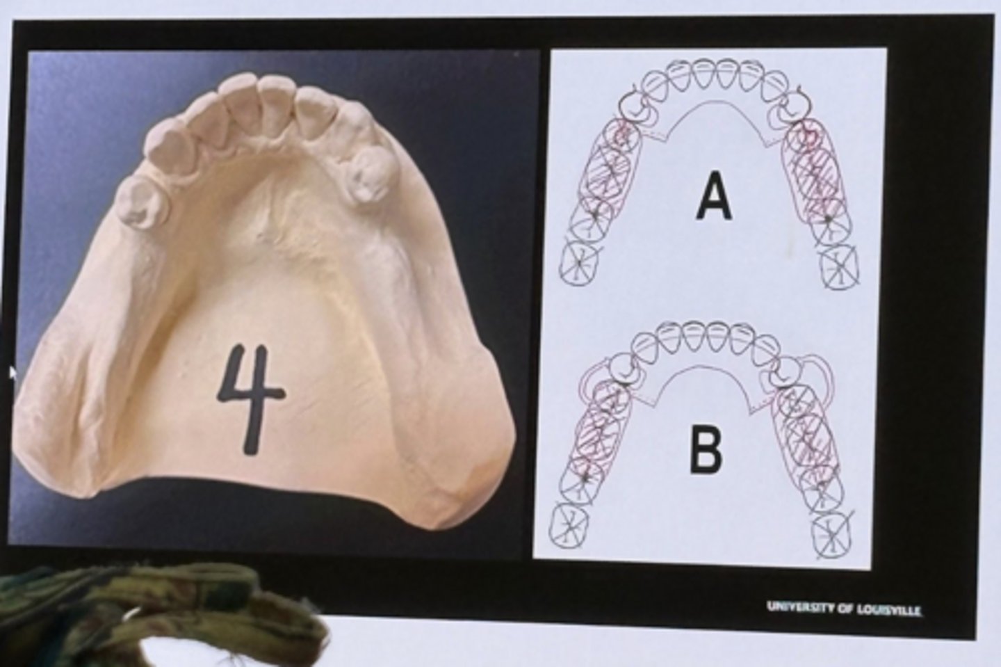 <p>-kennedy class 1</p><p>-a and b are ideal designs</p><p>-a or b are acceptable bc they stop 2/3 of the retromolar pad</p><p>-the i-bars in b are more esthetic</p>