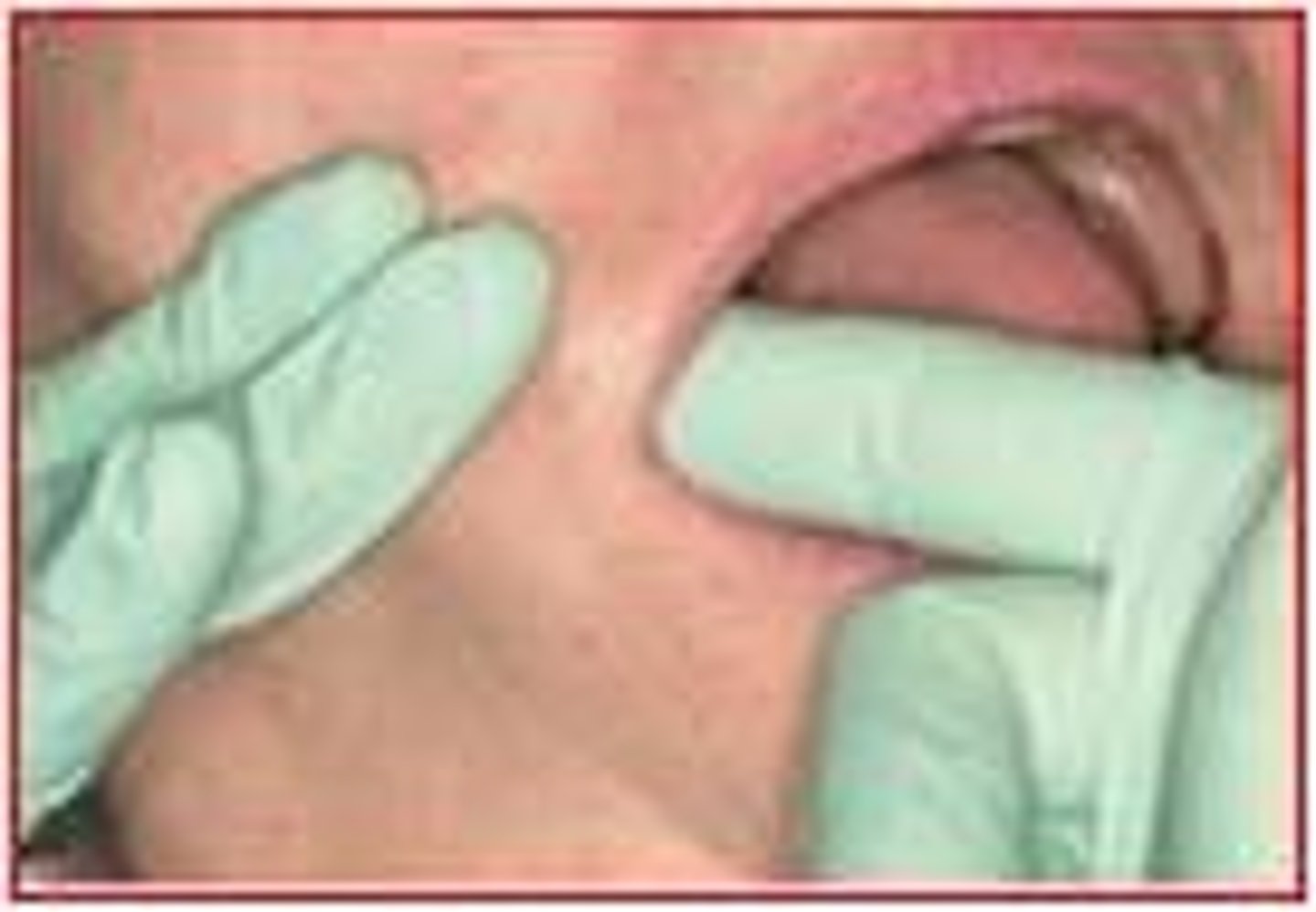 <p>Use finger of one hand and the thumb of the other hand simultaneously to move or compress tissue</p>