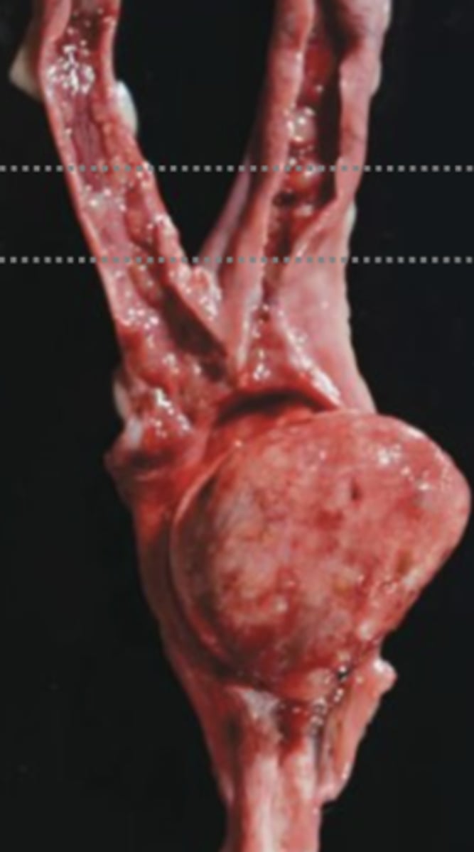 <p>What kind of tumor is this?</p>