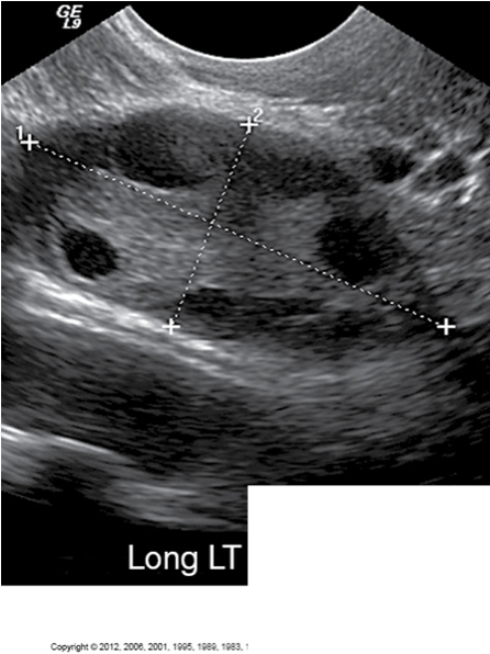 <p>Normal Appearance of Ovary</p>