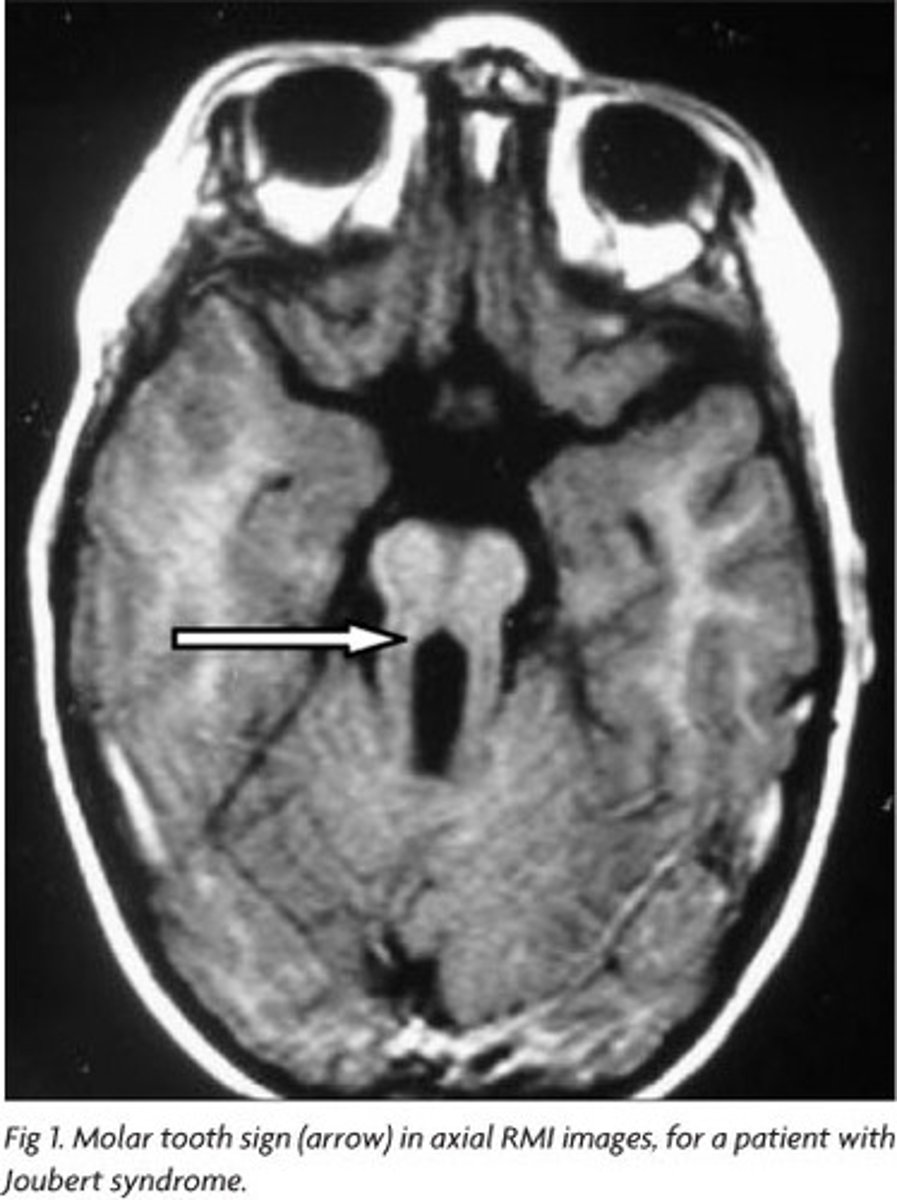 <p>MOLAR TOOTH SIGN due to elongation of superior cerebellar peduncles</p>