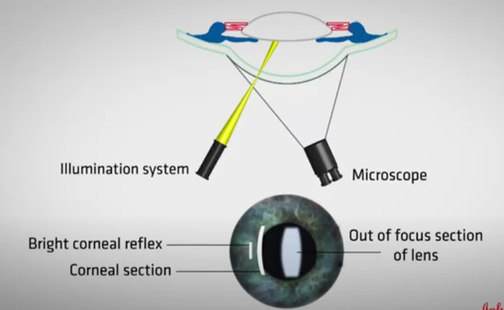 <p>Instructions to perform specular reflection after corneal section is formed </p>