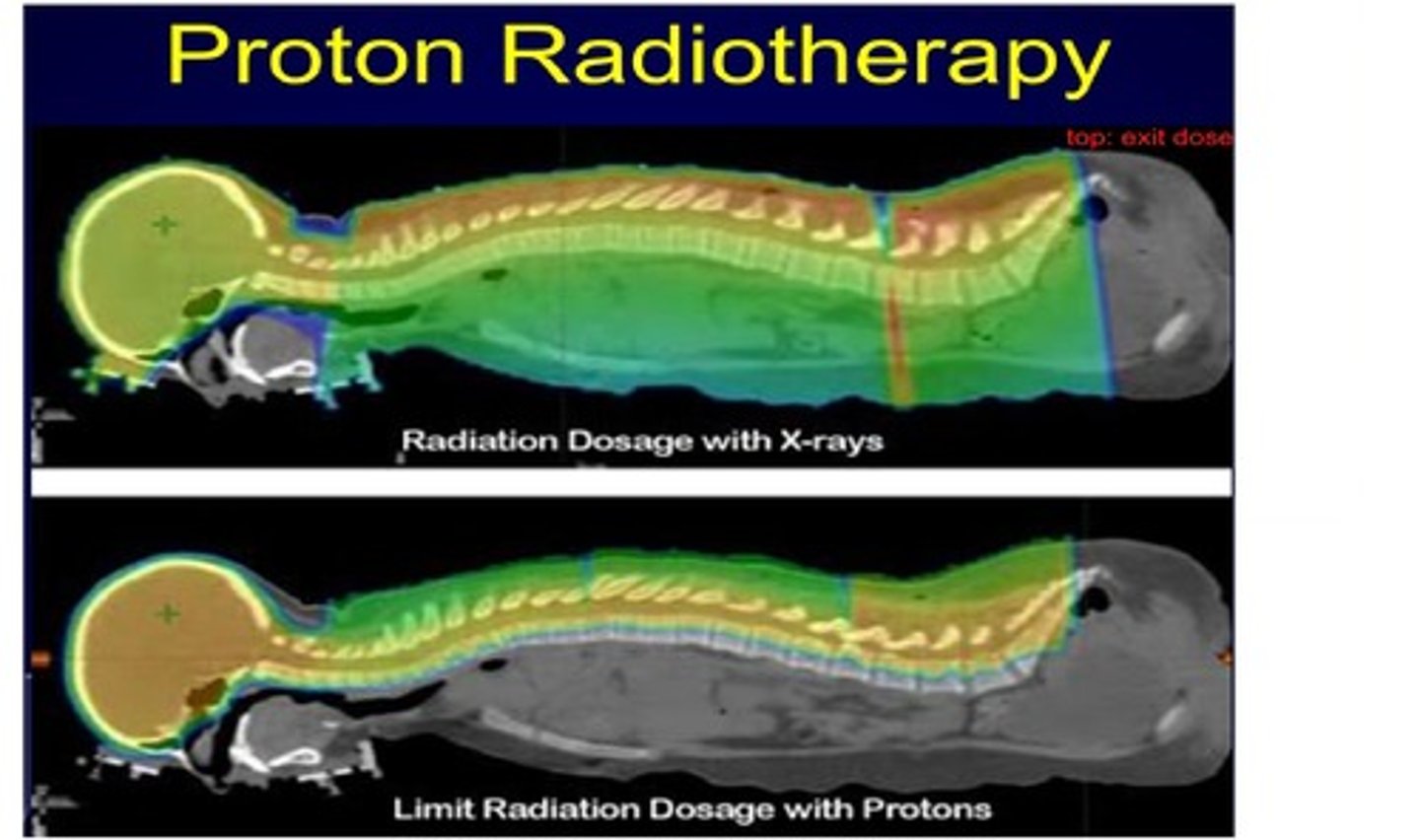 <p>Using radiation to treat specific areas inside the body. Used from the early 20th century to the present day. Often used with types of Cancer</p>