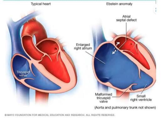 <ol><li><p>Low Thyroid hormone, </p></li><li><p>Heart (Ebstein anomaly), </p></li><li><p>Insipidus, </p></li><li><p>Unintentional Movement (tremors)</p></li></ol><p></p>