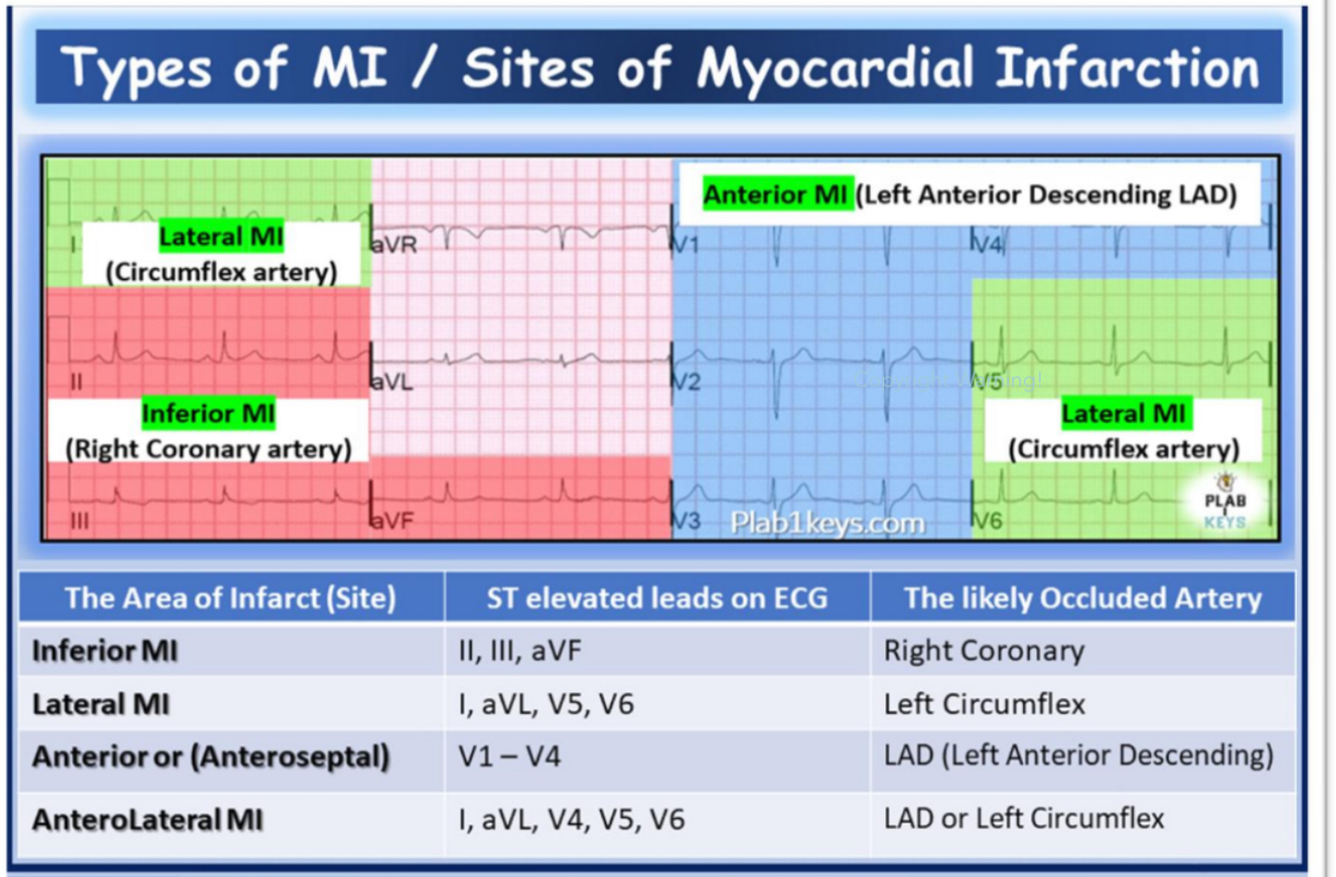 <p>Inferior MI</p><p>Lateral MI</p><p>Anteroseptal MI</p><p>AnteroLateral MI</p>