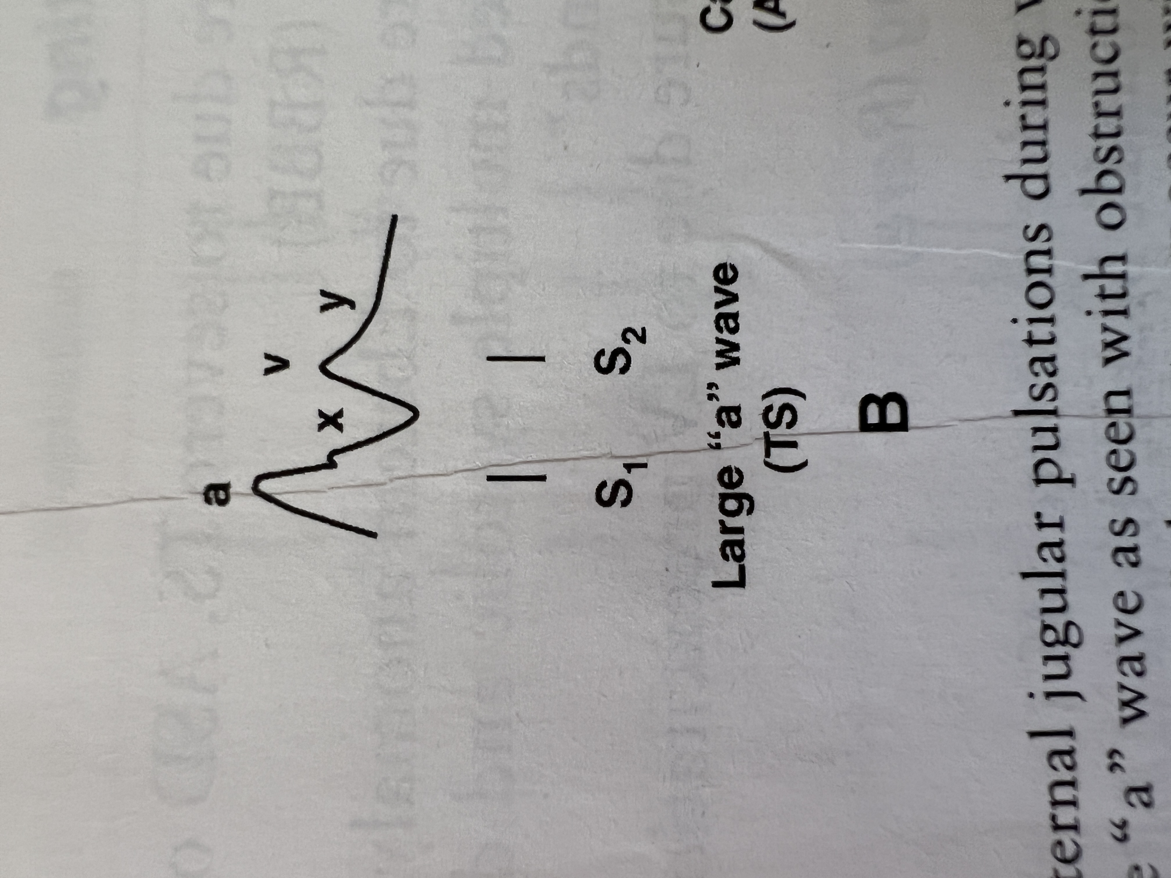 <p>In what condition would you observe a large 'a' wave with a slow 'y' descent?</p>