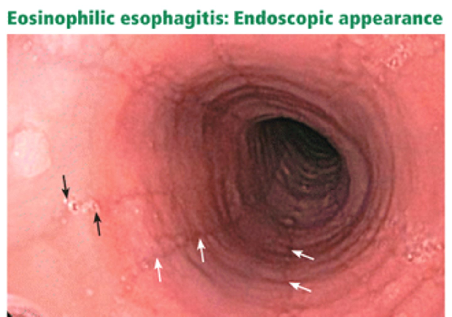 <p>eosinophilic esophagitis</p>