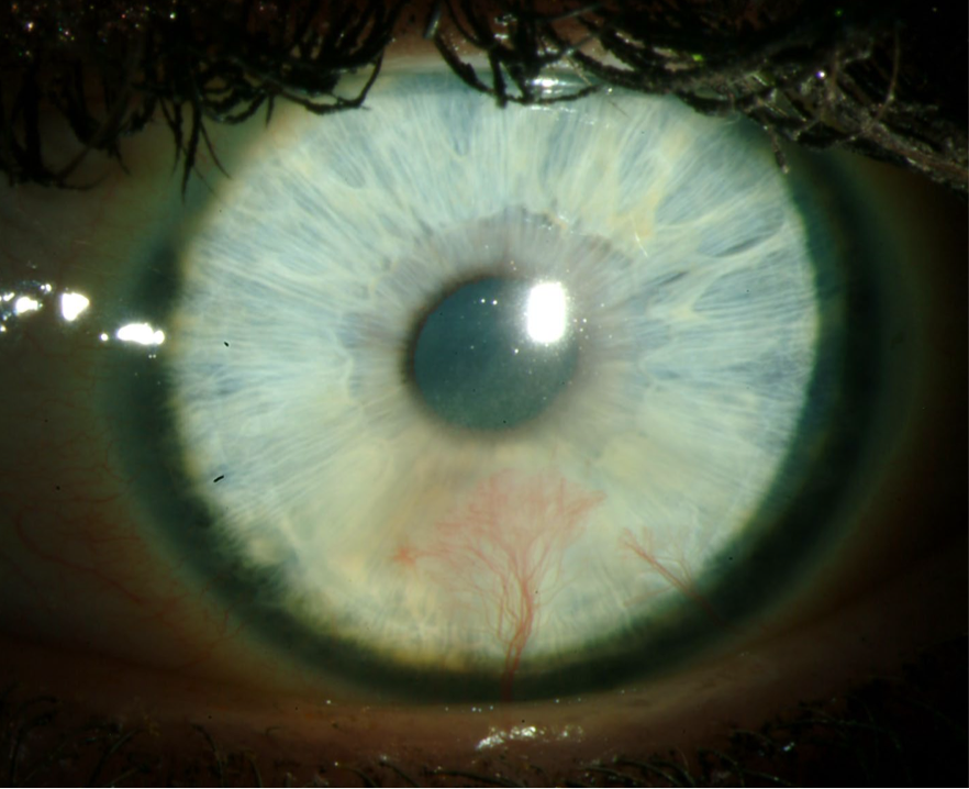 <ul><li><p><strong>Symptoms</strong>: blurred vision, photophobia, glare and halos</p></li><li><p><strong>Presentation</strong>:</p><ul><li><p>Stromal infiltrates with intact epithelium (neg stain)</p><ul><li><p>Infiltrates can be focal, multifocal or diffuse</p></li></ul></li><li><p>Stromal edema</p></li><li><p>Mild anterior uveitis</p></li><li><p>Chronic cases can cause stromal vascularization and corneal scarring</p><ul><li><p>Lipid deposition may also be seen</p></li></ul></li></ul></li></ul><p></p>