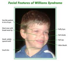 <p>an example of a contiguous gene syndrome</p><p>-caused by deletion 7q11.23, which is the elastin gene that codes for elastin protein in connective tissue</p><p>-phenotype: short statue, elf like features, satellite iris pattern, hypercalcemia, and vascular changes </p>