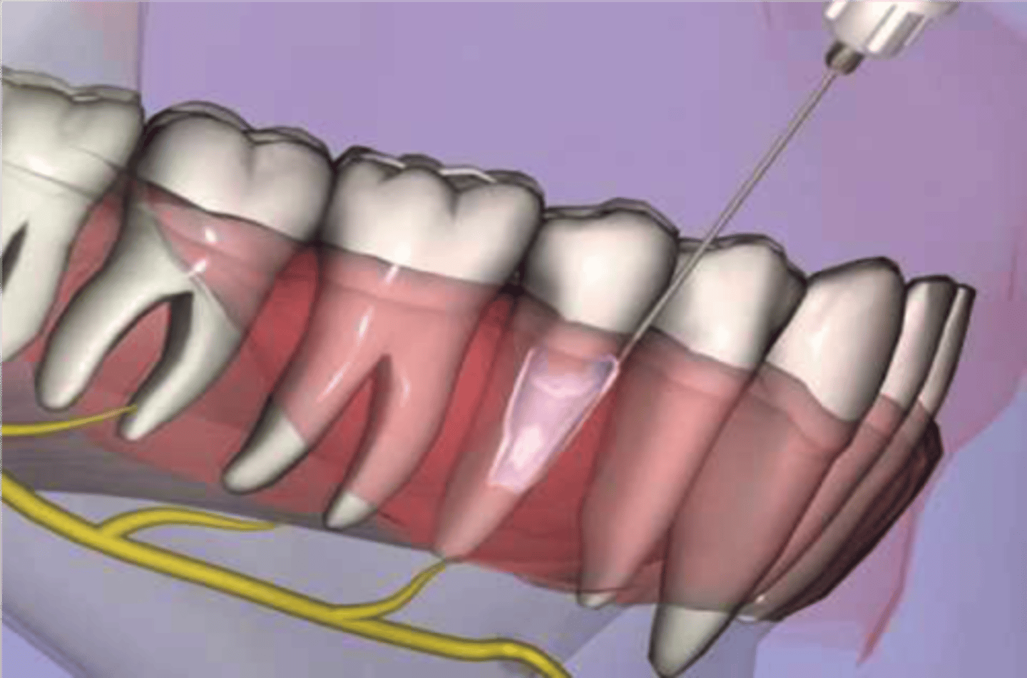 <p>anesthesia of a single tooth are localized raea through diffusion through soft tissue and bone adjacent to PDL</p>