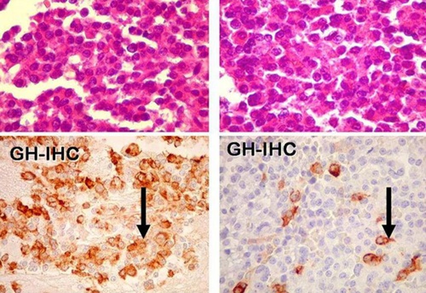<p>Define Adenoma:</p><p>SECOND MC type of FUNCTIONAL PitNET (10%)</p><p>-Path: Secrete Excess GH --&gt; Liver produce IGF-1 ==&gt; TISSUE GROWTH &amp; INSULIN RESISTANCE</p><p>**~40% have activating mutation in Gs-alpha protein subunit**</p><p>-Sx/PE:</p><p>&gt; GIGANTISM in Children (More Linear Bone Growth from UNFUSED Epiphyseal Plates)</p><p>&gt; ACROMEGALY in Adults (Disproportionate growth after epiphyseal plates fuse) --&gt; Enlarged hands, feet, jaw + Growth of Visceral Organs (Heart Failure) + Enlarged Tongue</p><p>&gt; Diabetes Mellitus (Insulin Resistance)</p>