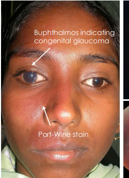 <p>bulphthalmos </p>