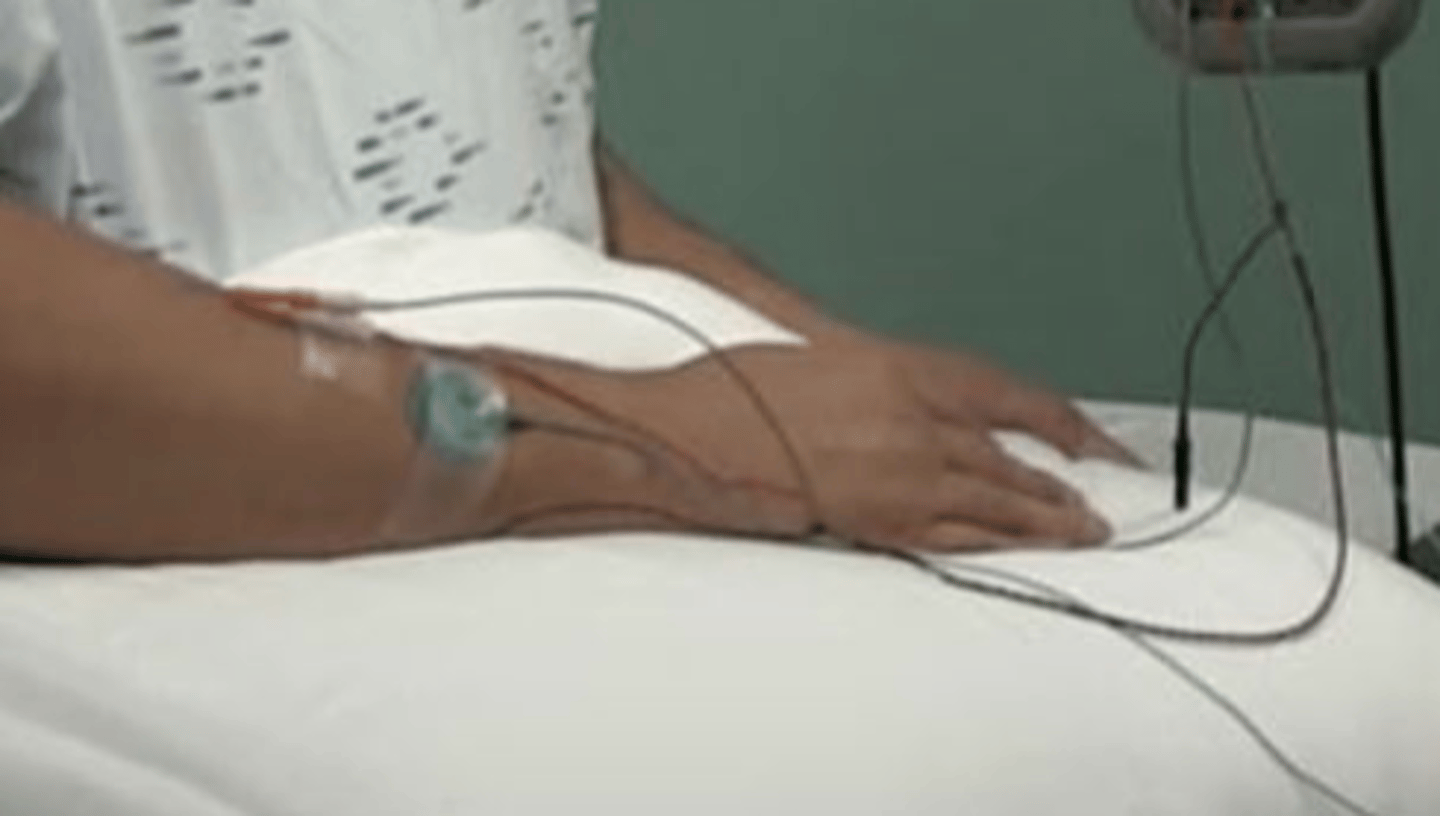 <p>By using a needle in this procedure, we know that this is likely a(n) ______________.</p><p>a. nerve conduction study</p><p>b. dry needling exam</p><p>c. EMG study</p><p>d. dermatomal screen</p>