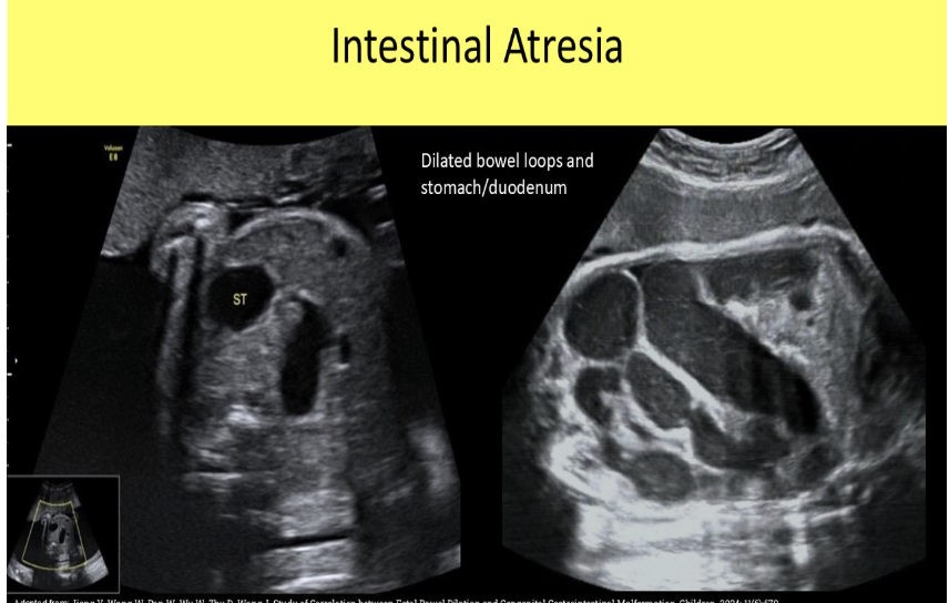 <p>which describes sono appearance of possible intestinal atresia in a 29w fetus</p><p>a) small bowel loops dilated at 3mm luminal diameter</p><p>b) decreased or absent peristalsis of bowel</p><p>c) hyperechoic bowel w/increased peristalsis</p><p>d) pleural effusion, megacystitis + ascites </p>