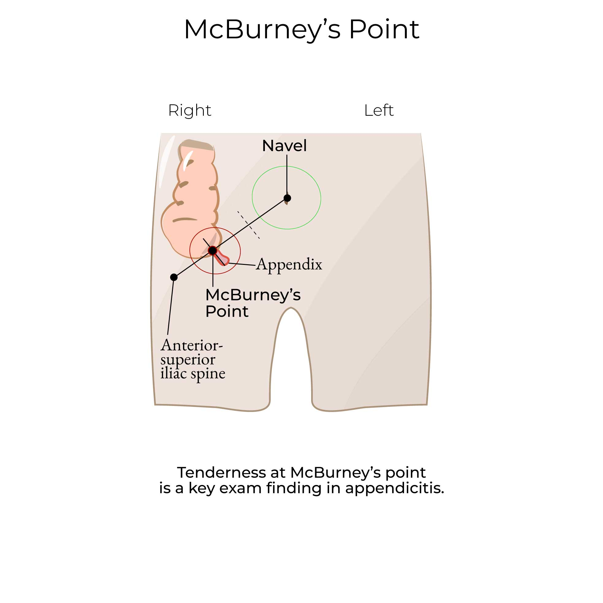 <ul><li><p><span><mark data-color="#ffffff" style="background-color: #ffffff; color: inherit">Location on the lower right side of the abdomen that is 1/3rd of the way between the anterior superior iliac spine and the umbilicus.</mark></span></p></li><li><p><span><mark data-color="#ffffff" style="background-color: #ffffff; color: inherit">It is a key landmark in the physical examination for</mark><strong><mark data-color="#ffffff" style="background-color: #ffffff; color: inherit"> appendicitis</mark></strong><mark data-color="#ffffff" style="background-color: #ffffff; color: inherit">, as tenderness at this point is a strong indicator of inflammation of the appendix.</mark></span></p></li></ul><p></p>