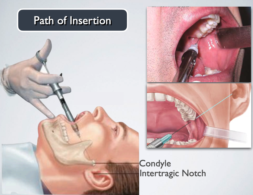 <ul><li><p>Lateral aspect of condylar neck</p></li><li><p>Use both intra-oral and extra-oral landmarks to establish the path of insertion</p></li></ul><img src="https://knowt-user-attachments.s3.amazonaws.com/8698a074-453d-4fd1-9187-1b5afd2a83af.png" data-width="100%" data-align="center"><p></p>