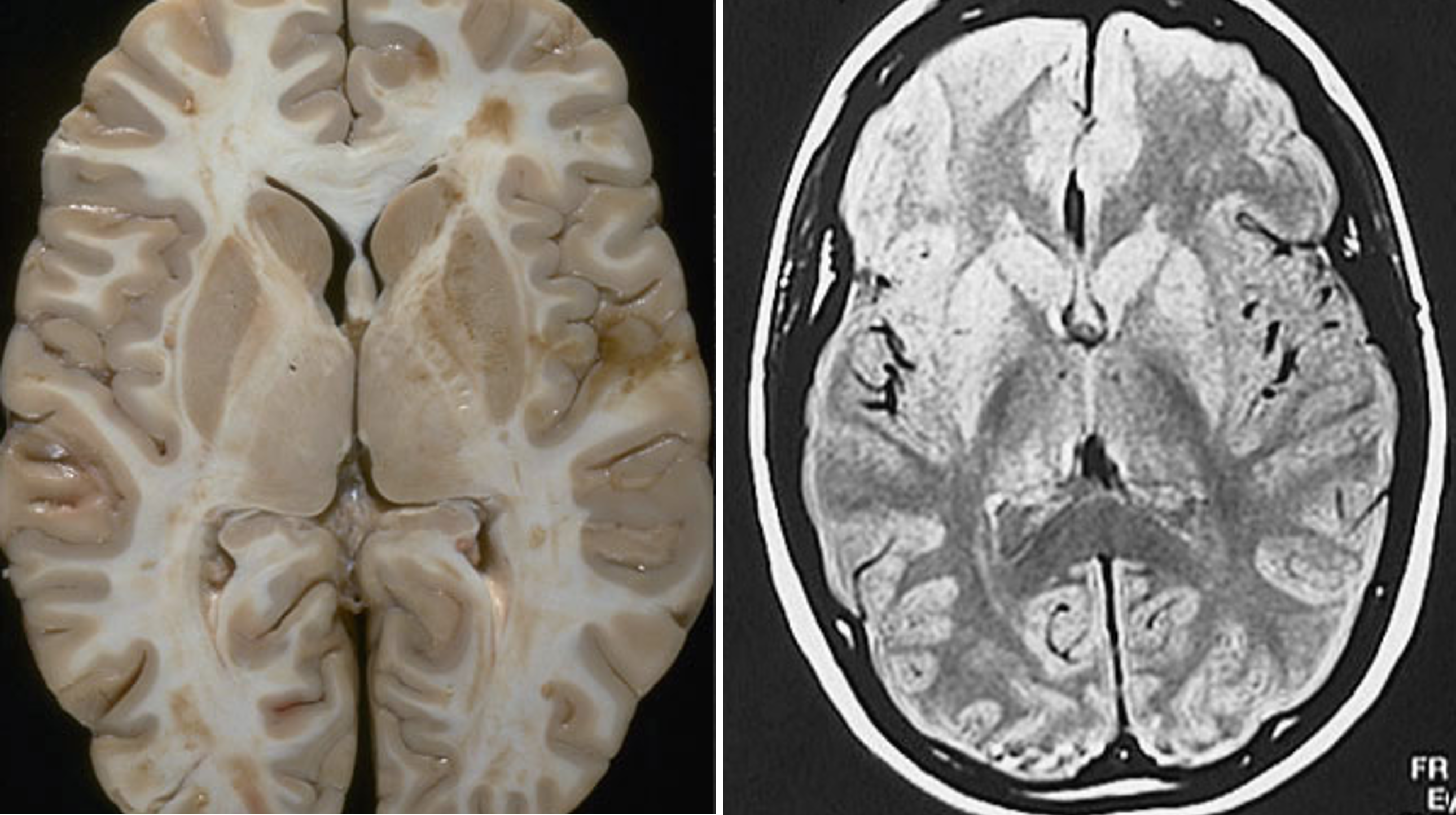 <p>the basal ganglia are large structures that are easily identified in structural MRI scans</p>