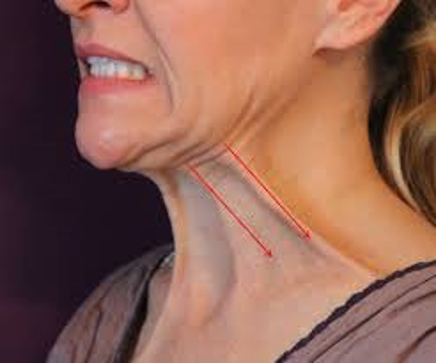 <p>superficial neck muscles, "eek face"</p>