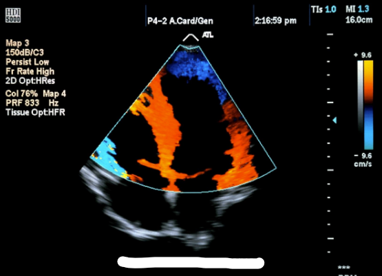 <p>uses color doppler (filter is set to low velocity, high amplitude</p>