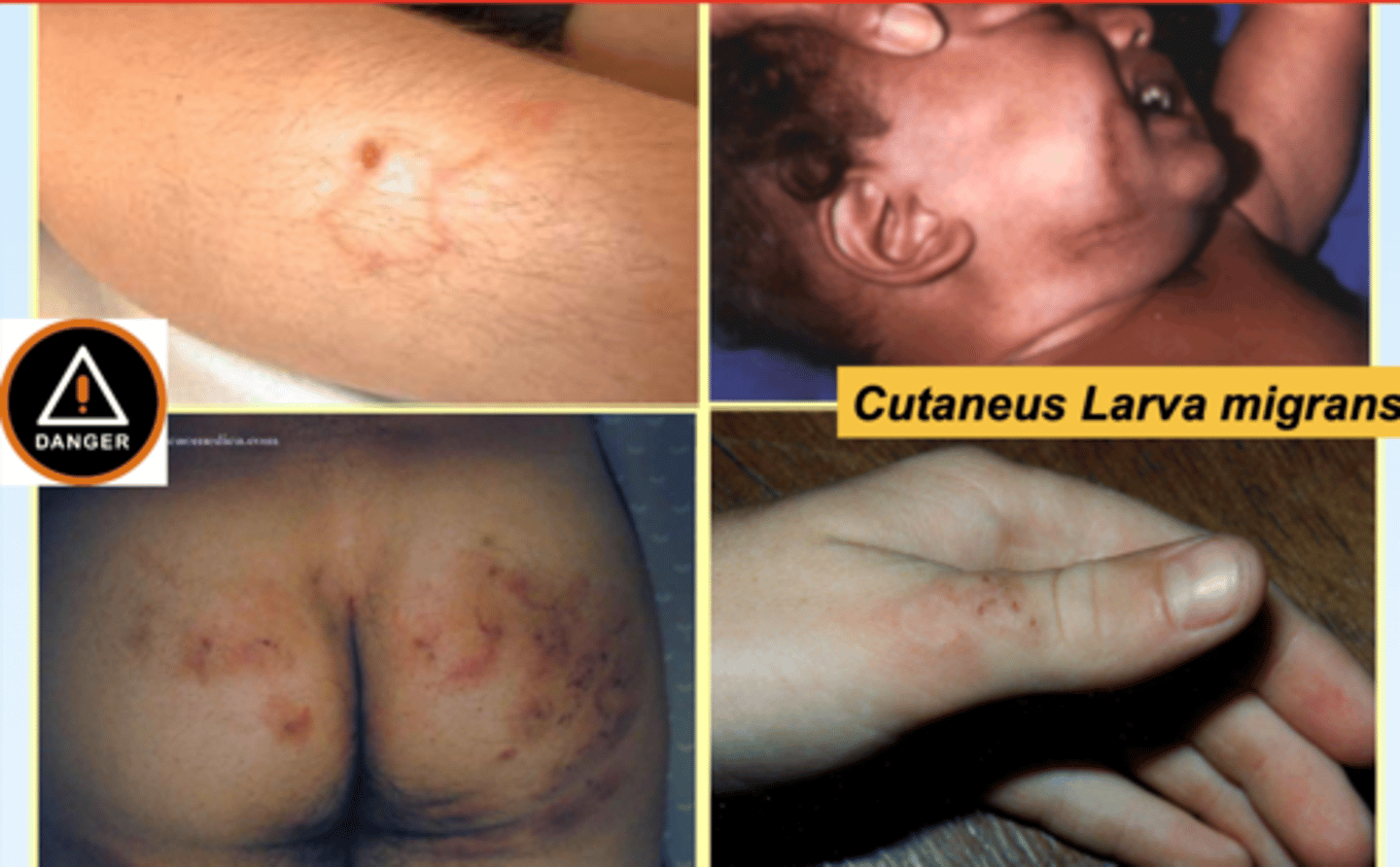 <p>what parasite causes cutaneous larva migrans in humans?</p>