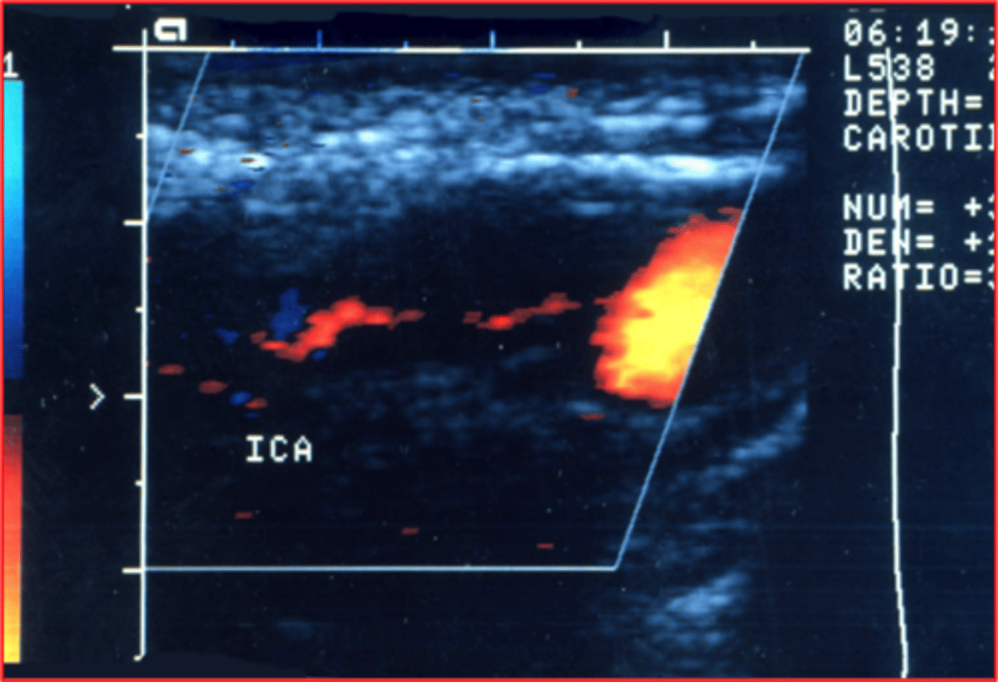 <p>This is seen just before an occlusion occurs and is considered an emergency</p>