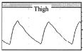 <ol><li><p>Broadened waveform </p></li><li><p>Absent dicrotic notch or reflected waveform </p></li><li><p>Slight loss of amplitude </p></li></ol><p></p>