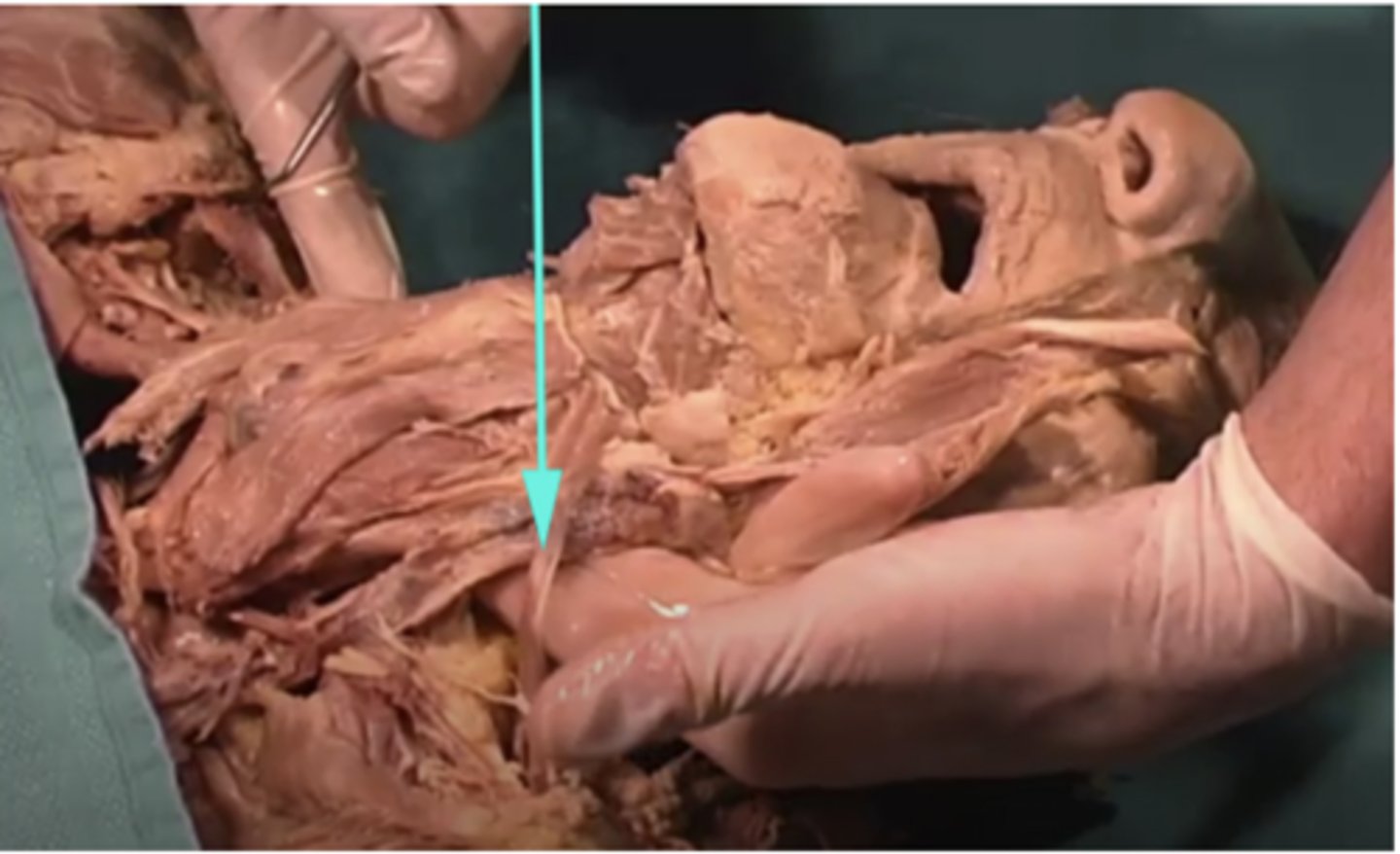 <p>What is the name of the structure as indicated by the arrow?</p><p>-sternocleidomastoid</p><p>-subcutaneous fascia</p><p>-omohyoid</p><p>-integral proteins</p>