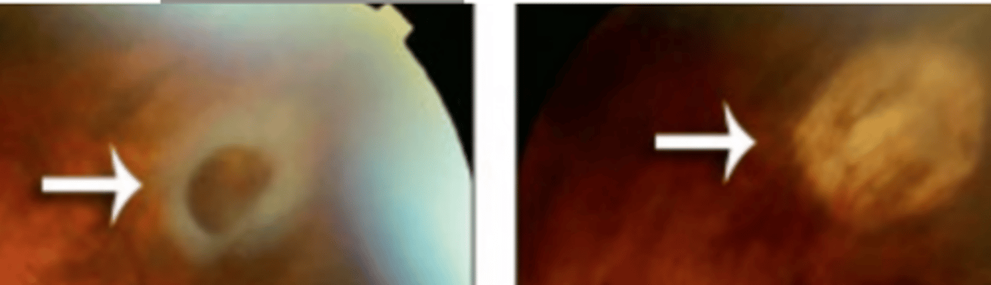 <p>prophylactic procedure where cold is applied to the sclera in order to create a scar and seal the retina preventing a detachment. Is performed in areas where laser photocoagulation is difficult to perform, but is usually not preferred over photocoagulation because it is not as precise and is more painful for the patient.</p>