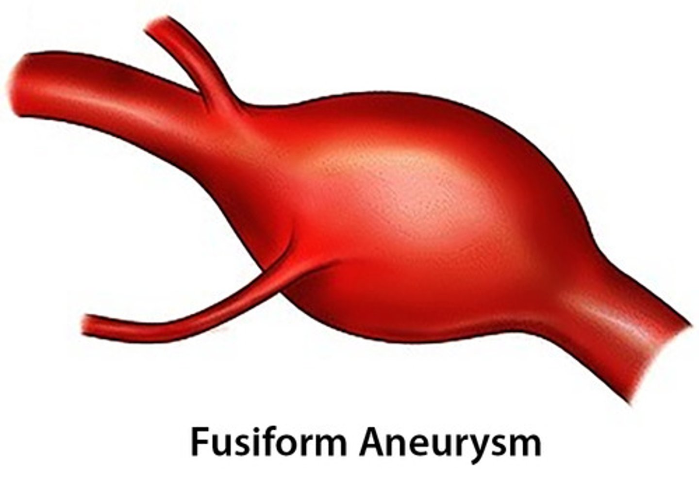 <p>-involves complete circumference of artery</p><p>-symmetrical</p>