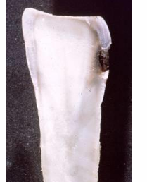 <p>-initially a broad preferential spread along DEJ</p>