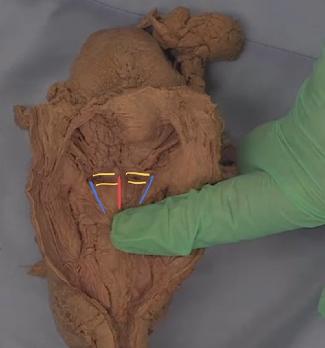 <p>What is the fold colored blue? (constrictor muscles are reflected, epiglottis is pushed down)</p>