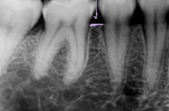 <p>both on maxillae and mandible</p>