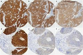 <p>Why is p16 a surrogate marker for HR-HPV?</p>