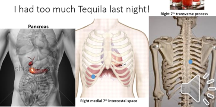 <p>anterior point: right medial 7th intercostal space<br>posterior point: right 7th transverse process</p>