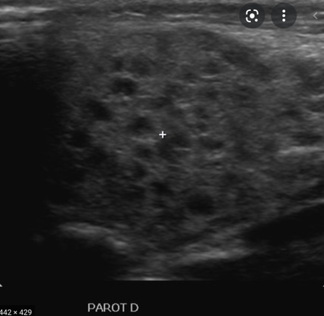 <p>Etiology</p><p>-Chronic sialadenitis (salivary gland infection)</p><p>-Present 3-6 yrs of age </p><p>-More common in males</p><p>Clinical findings</p><p>-Pain and swelling especially postprandial</p><p>Sonographic findings</p><p>-Enlarged heterogeneous gland(s)</p><p>-Excretory duct(s) may be dilated</p><p>-Sialolithiasis (presence of calculi in the salivary glands or ducts)</p><p>-Normal vascular flow </p>