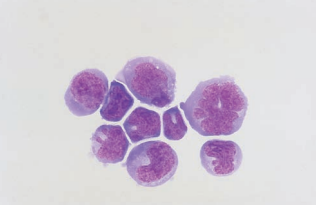 Figure 20: Cleaved and uncleaved lymphoma cells