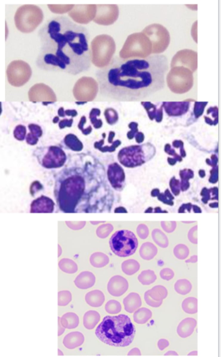 <p>What type of inflammatory cells are these?</p>