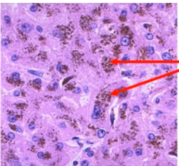 <p><span style="font-family: arial">Pigment granules that appear brown in color; pigment produced from the lysosomal digestion of hemoglobin</span></p>
